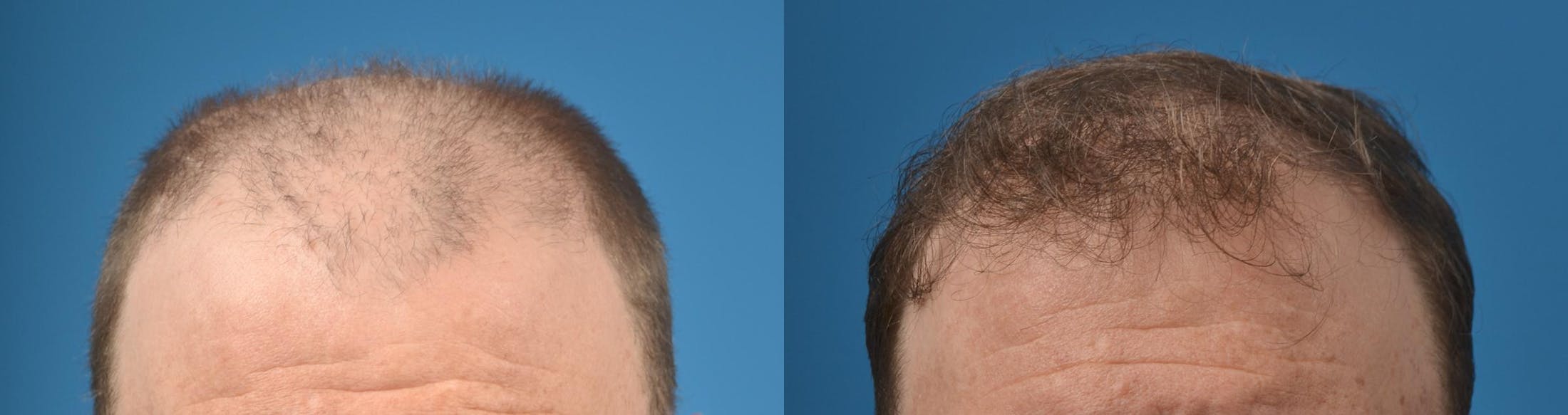 Hair Restoration Before & After Gallery - Patient 122405280 - Image 3