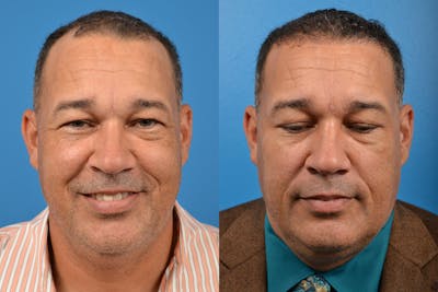 Hair Restoration Before & After Gallery - Patient 122405286 - Image 1