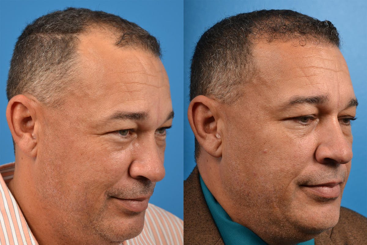 Hair Restoration Before & After Gallery - Patient 122405286 - Image 2