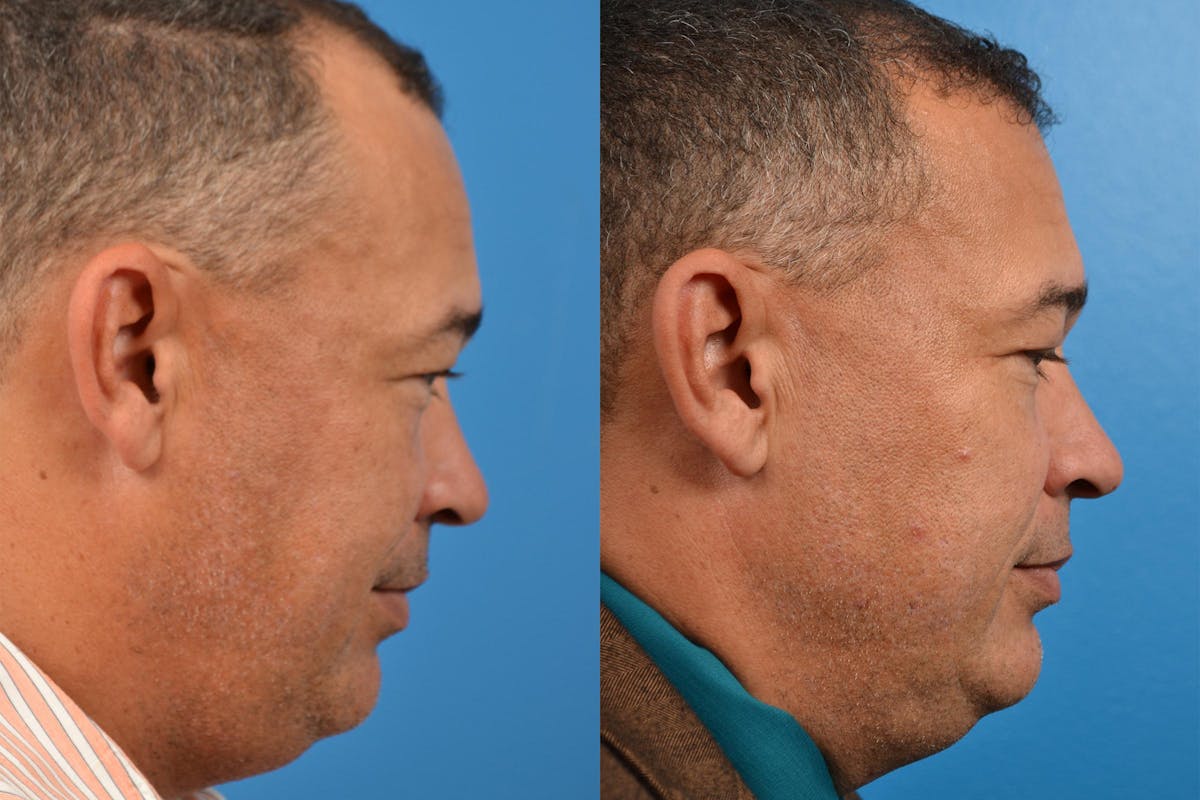 Hair Restoration Before & After Gallery - Patient 122405286 - Image 3
