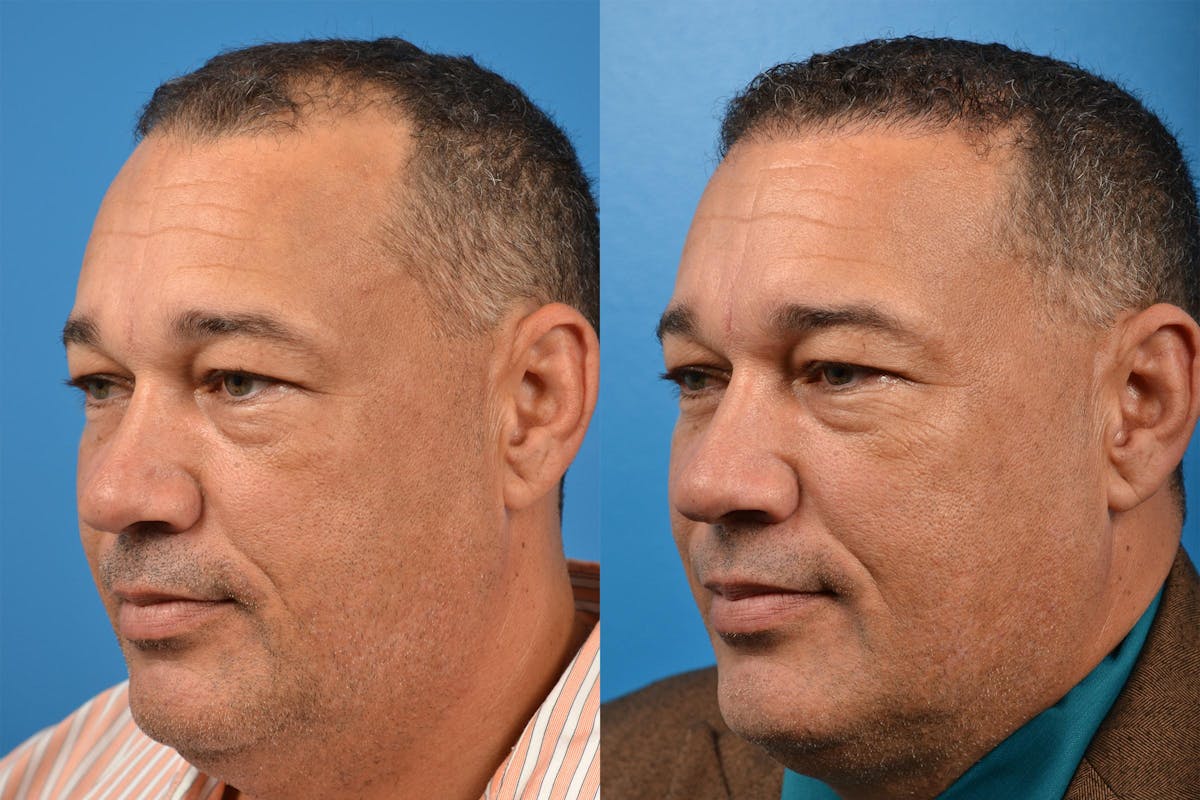 Hair Restoration Before & After Gallery - Patient 122405286 - Image 4