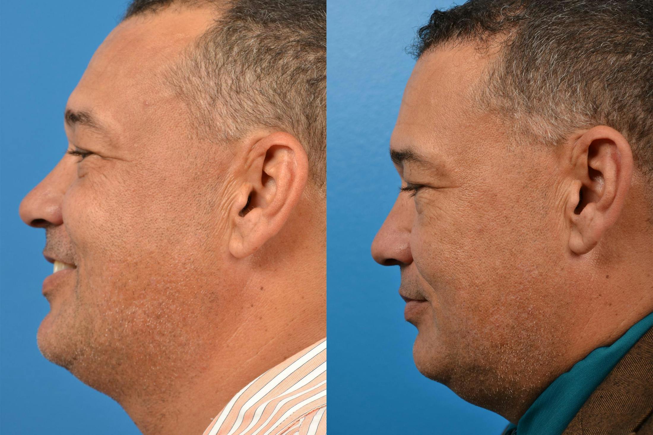 Hair Restoration Before & After Gallery - Patient 122405286 - Image 5