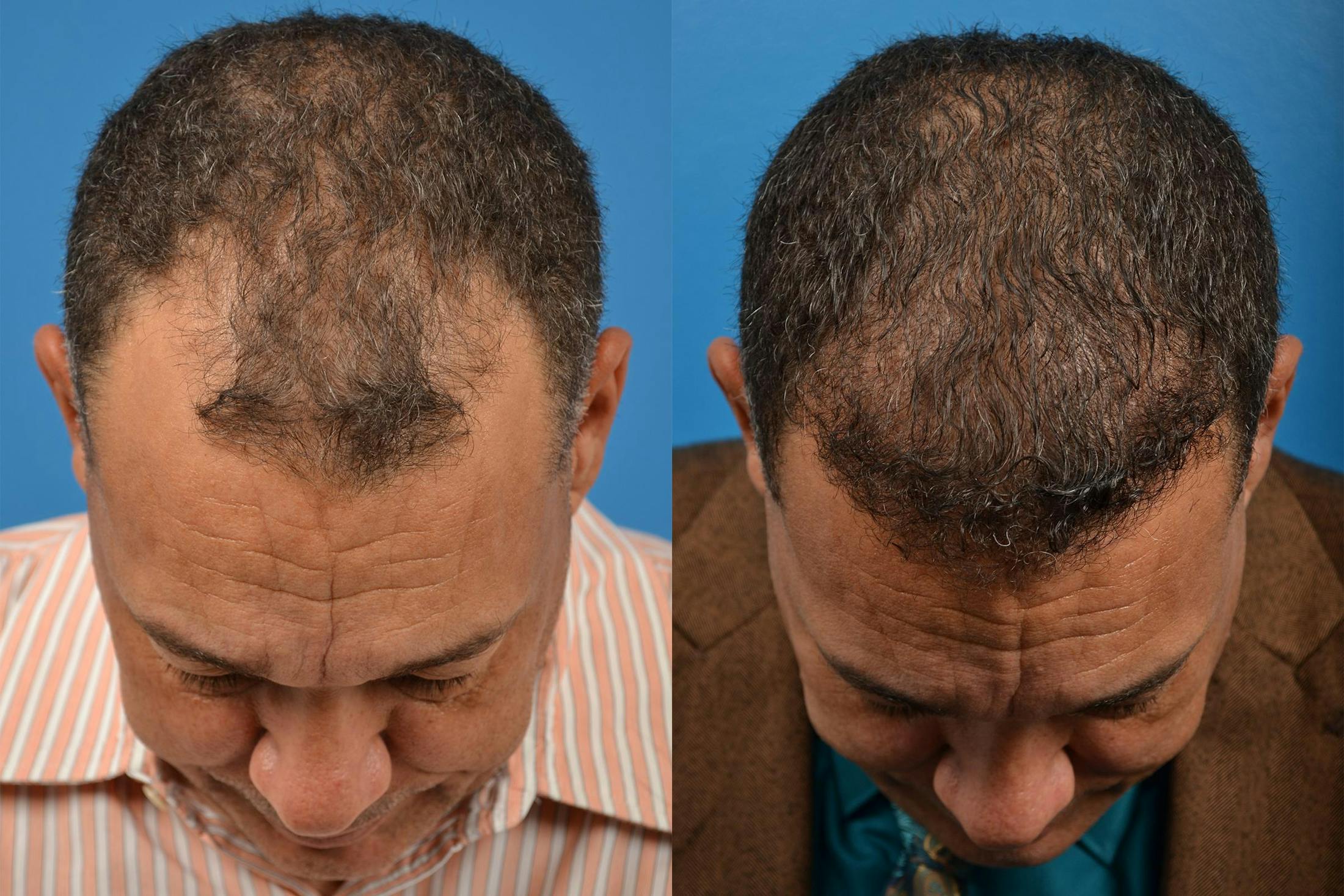 Hair Restoration Before & After Gallery - Patient 122405286 - Image 6