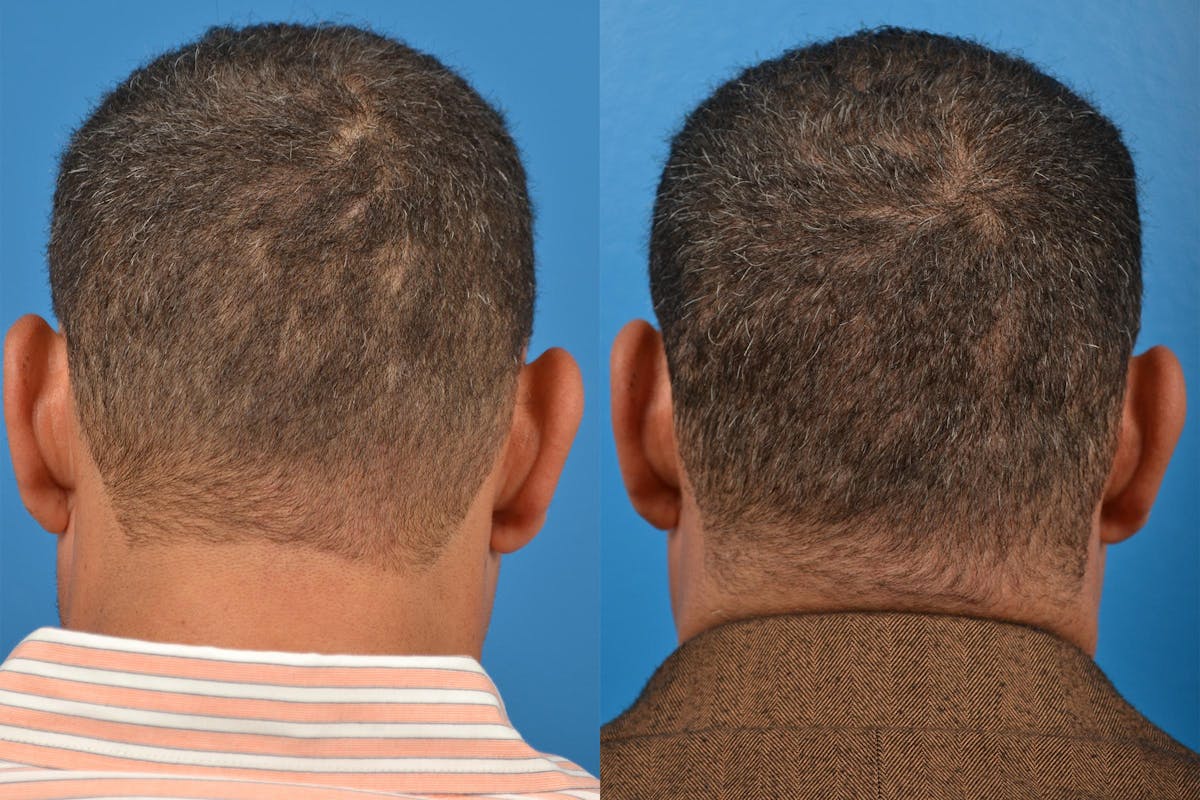 Hair Restoration Before & After Gallery - Patient 122405286 - Image 7