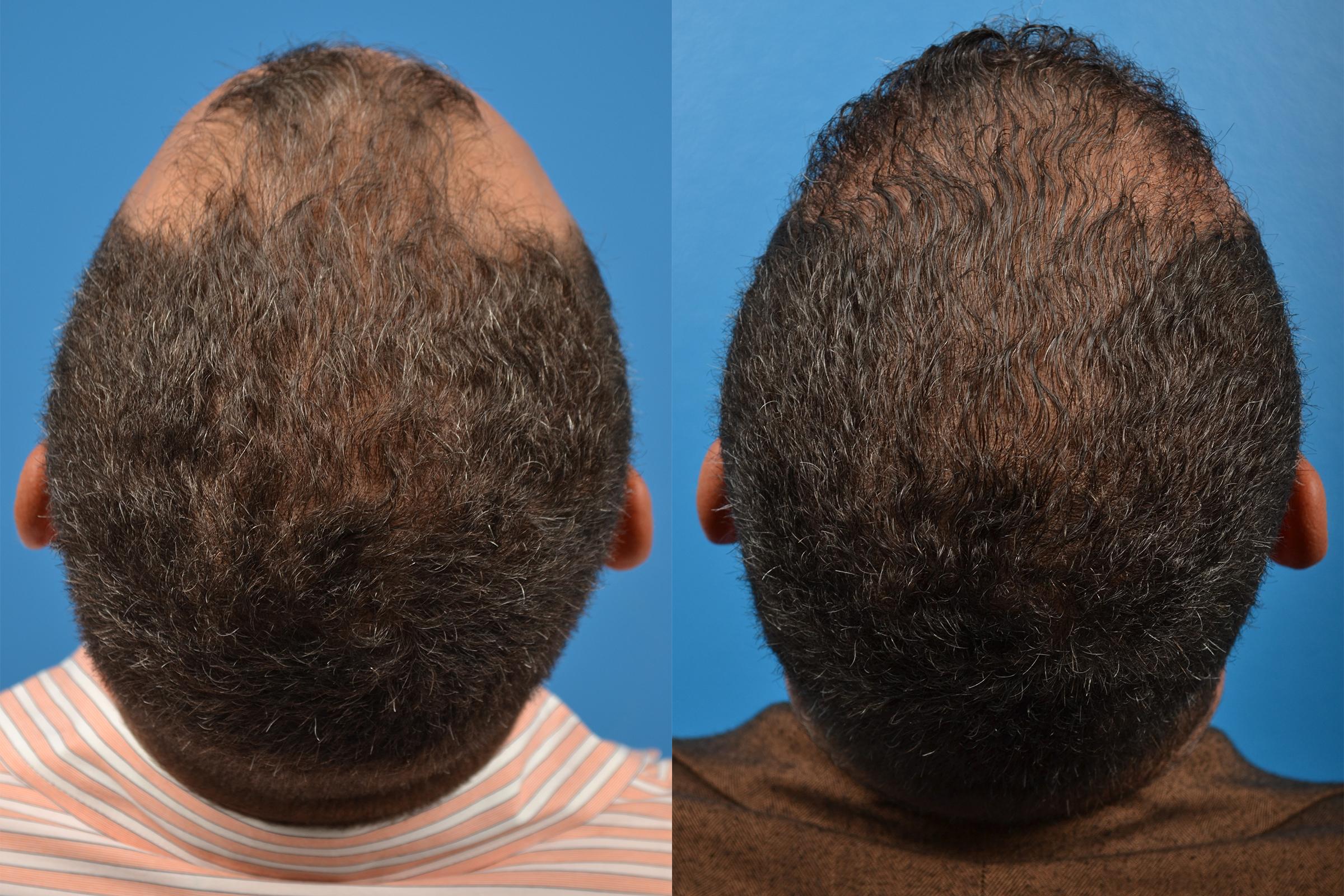 Hair Restoration Before & After Gallery - Patient 122405286 - Image 8