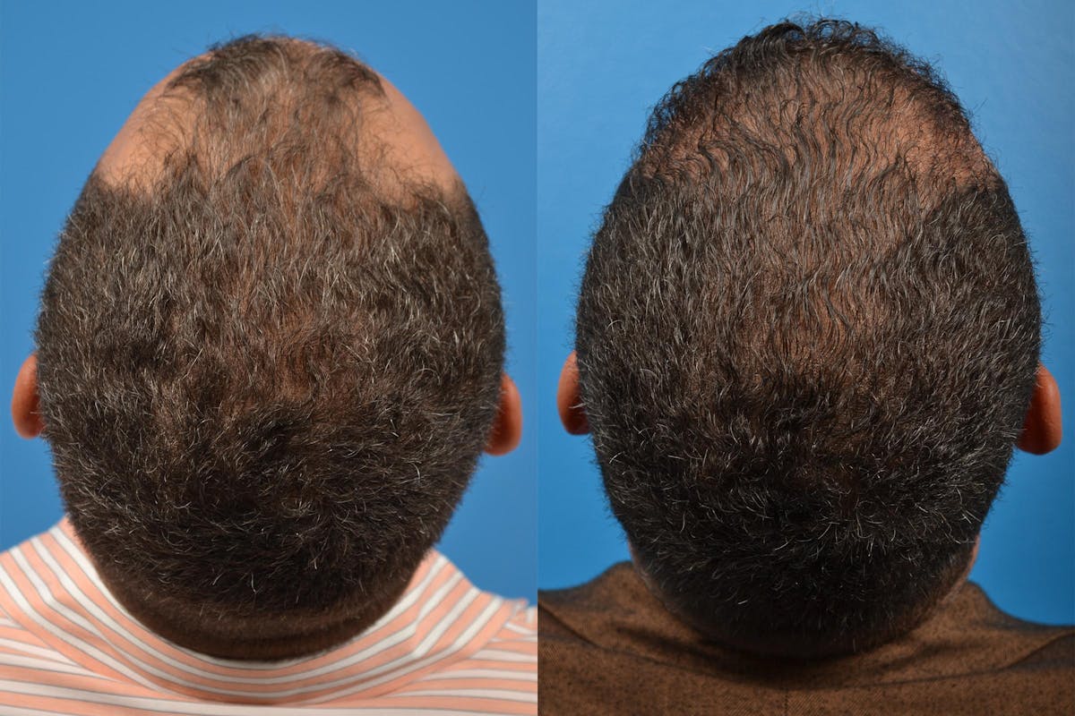 Hair Restoration Before & After Gallery - Patient 122405286 - Image 8