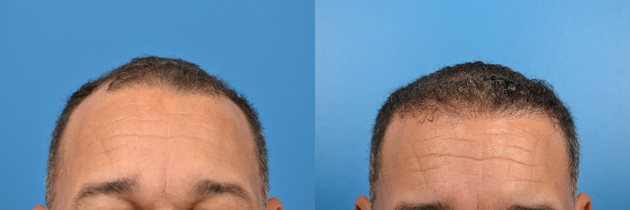 Hair Restoration Before & After Gallery - Patient 122405286 - Image 9