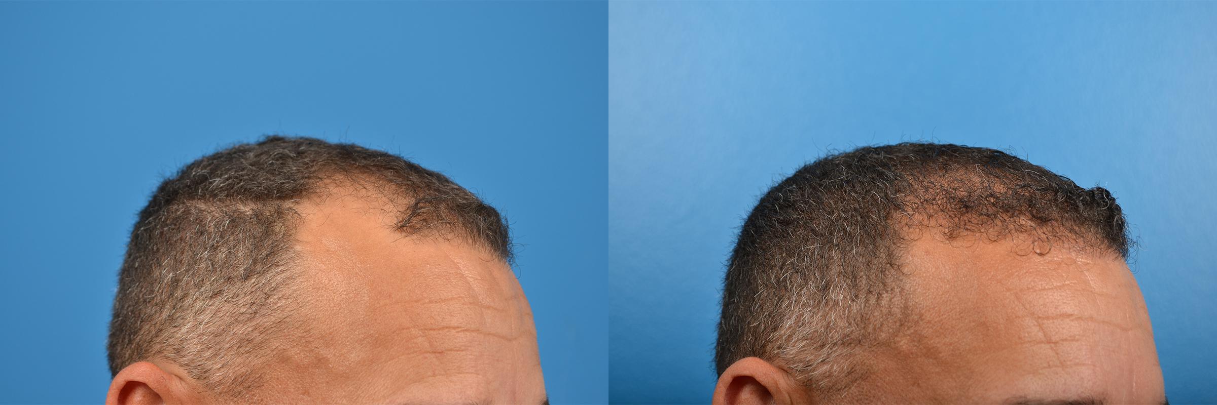 Hair Restoration Before & After Gallery - Patient 122405286 - Image 10