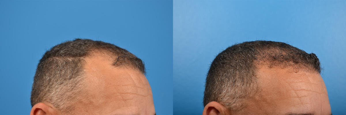 Hair Restoration Before & After Gallery - Patient 122405286 - Image 10