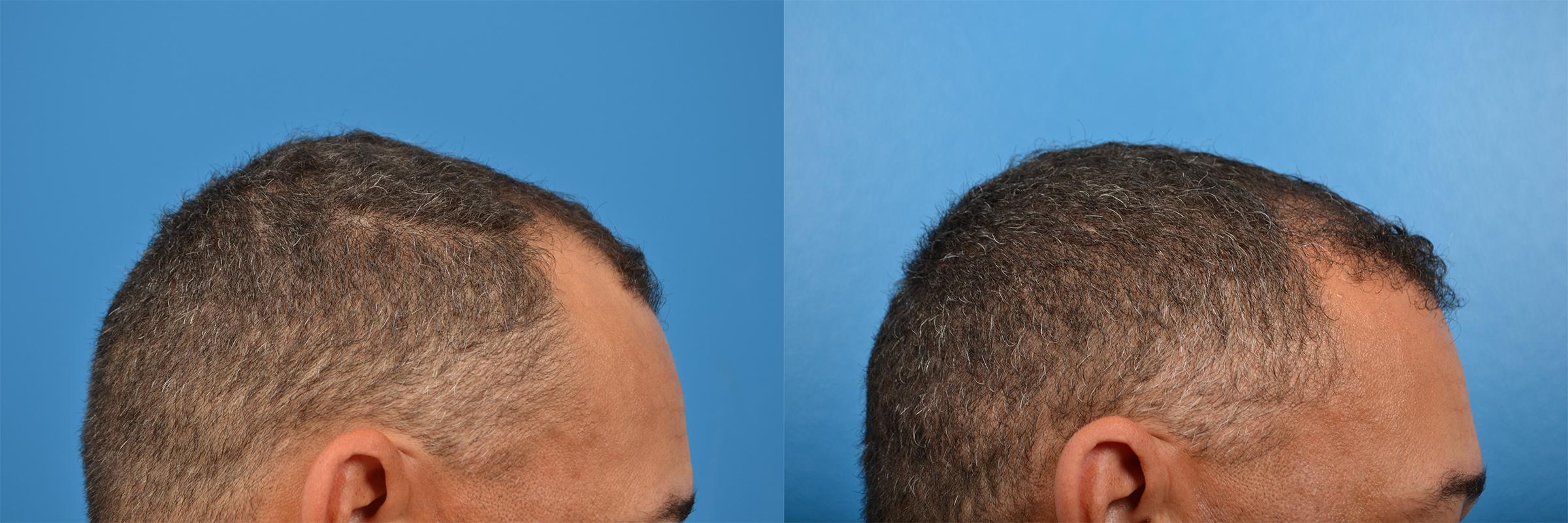 Hair Restoration Before & After Gallery - Patient 122405286 - Image 11