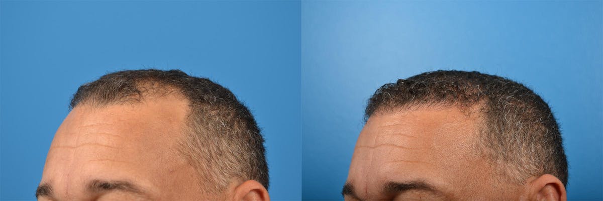 Hair Restoration Before & After Gallery - Patient 122405286 - Image 12
