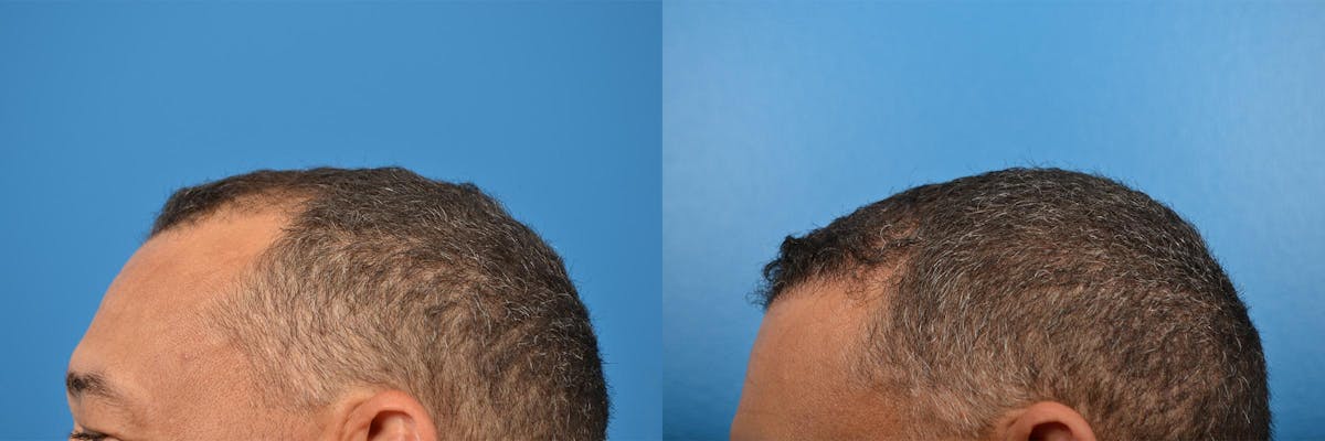 Hair Restoration Before & After Gallery - Patient 122405286 - Image 13