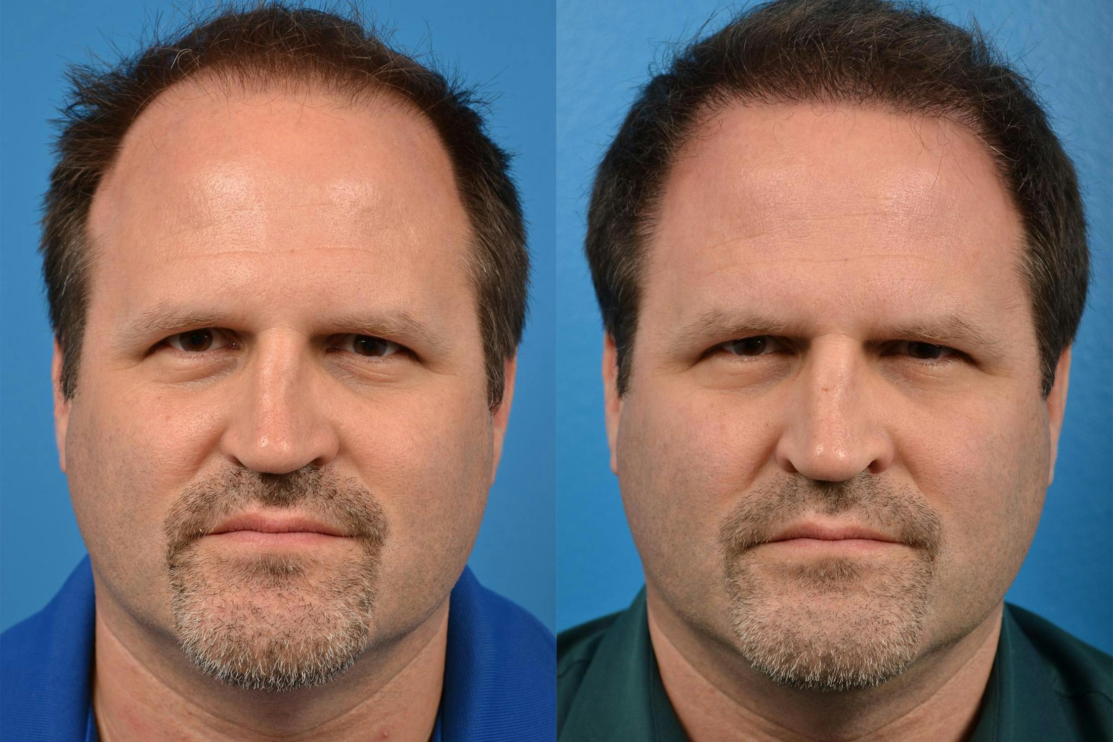 Hair Restoration Before & After Gallery - Patient 122405291 - Image 1