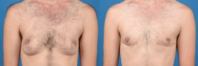 Female to Male Top Surgery Before & After Gallery - Patient 122595427 - Image 1