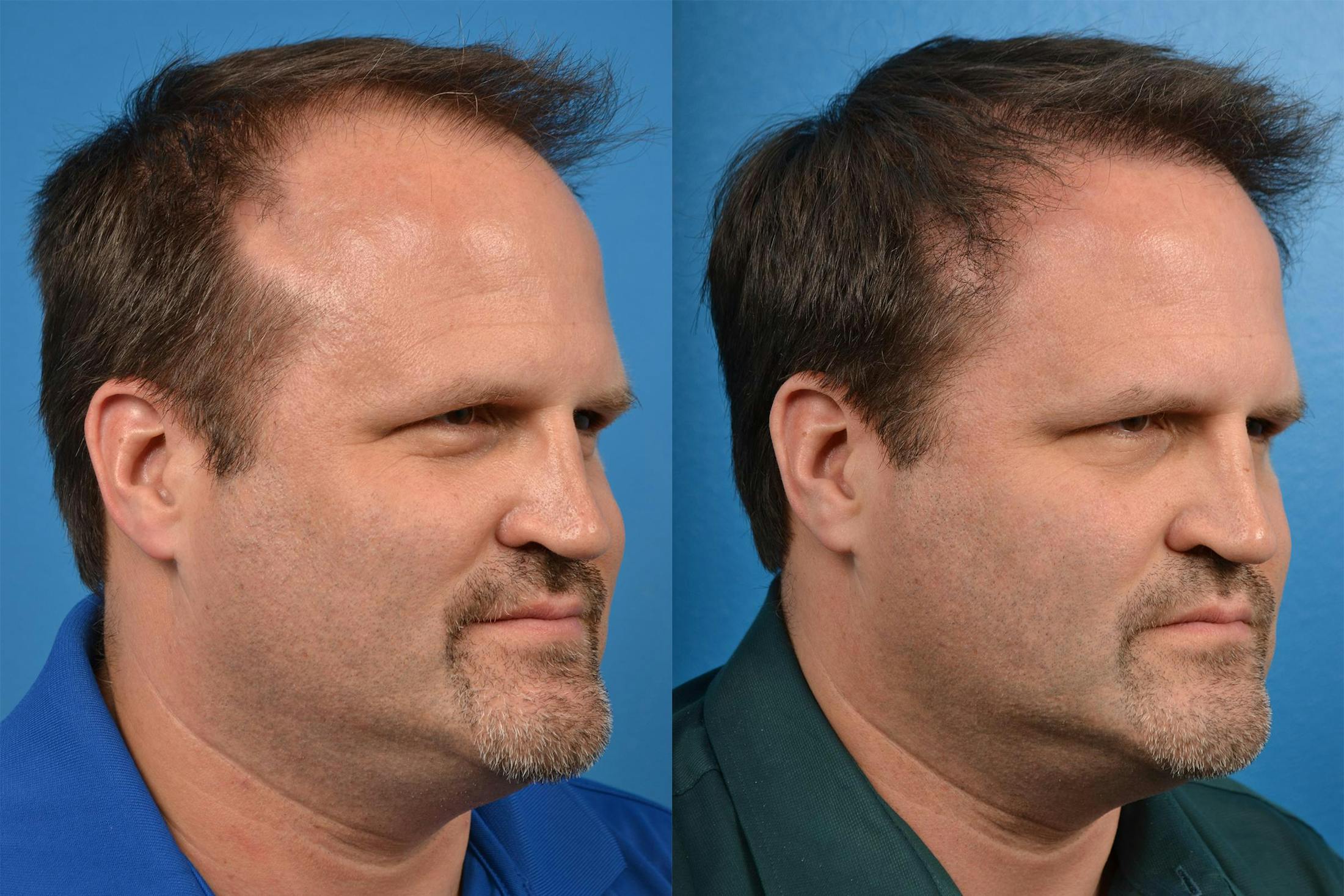 Hair Restoration Before & After Gallery - Patient 122405291 - Image 2