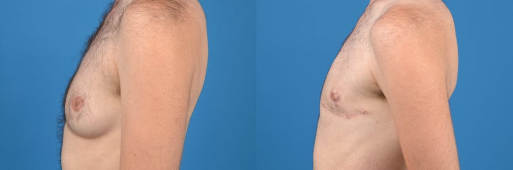Female to Male Top Surgery Before & After Gallery - Patient 122595427 - Image 2