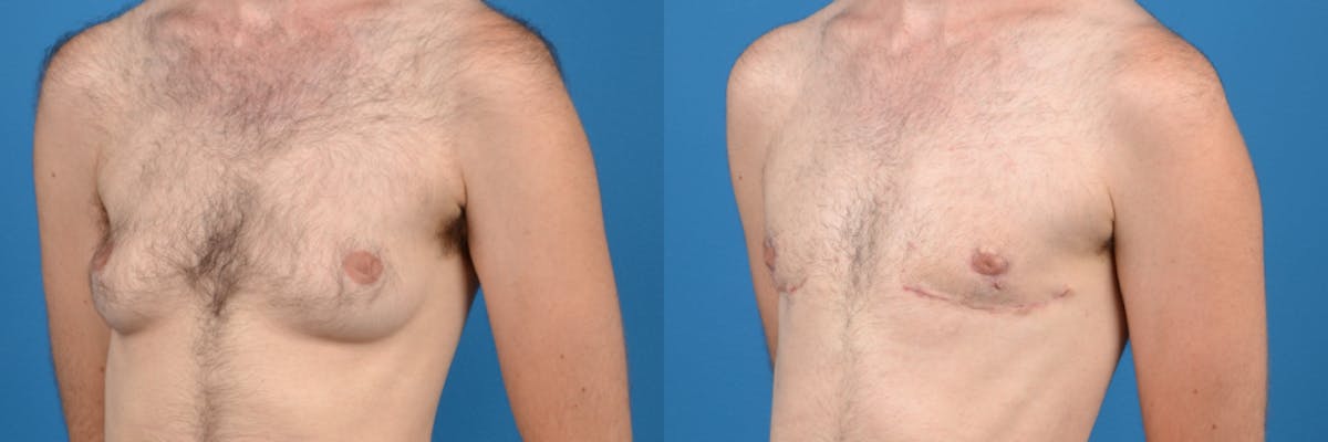 Female to Male Top Surgery Before & After Gallery - Patient 122595427 - Image 3