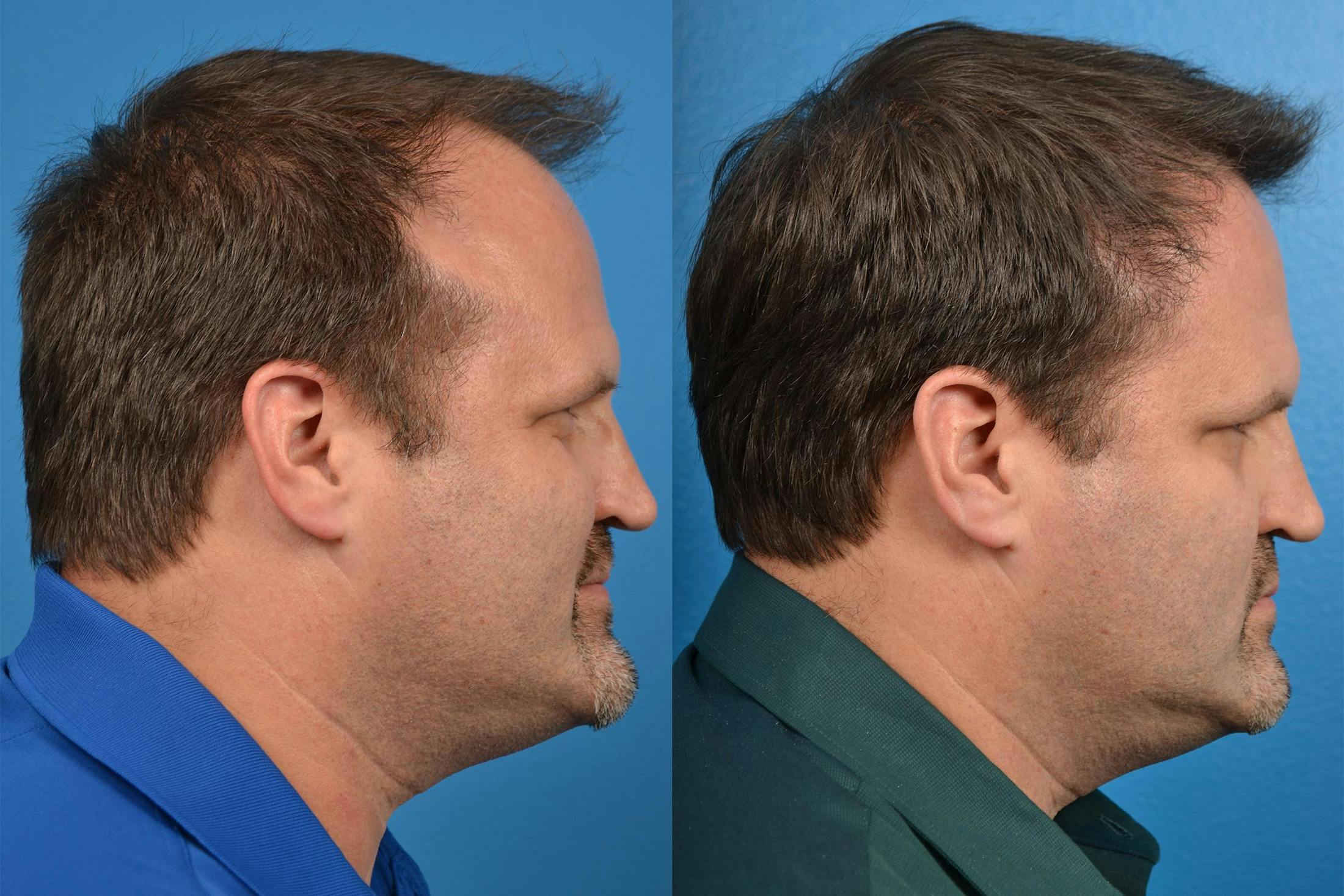 Hair Restoration Before & After Gallery - Patient 122405291 - Image 3