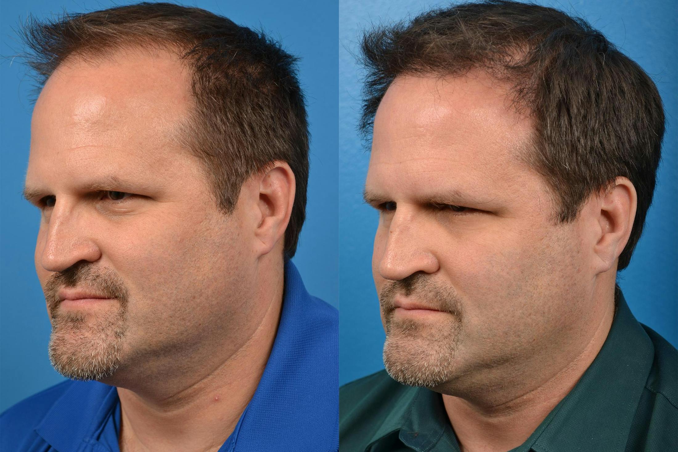 Hair Restoration Before & After Gallery - Patient 122405291 - Image 4