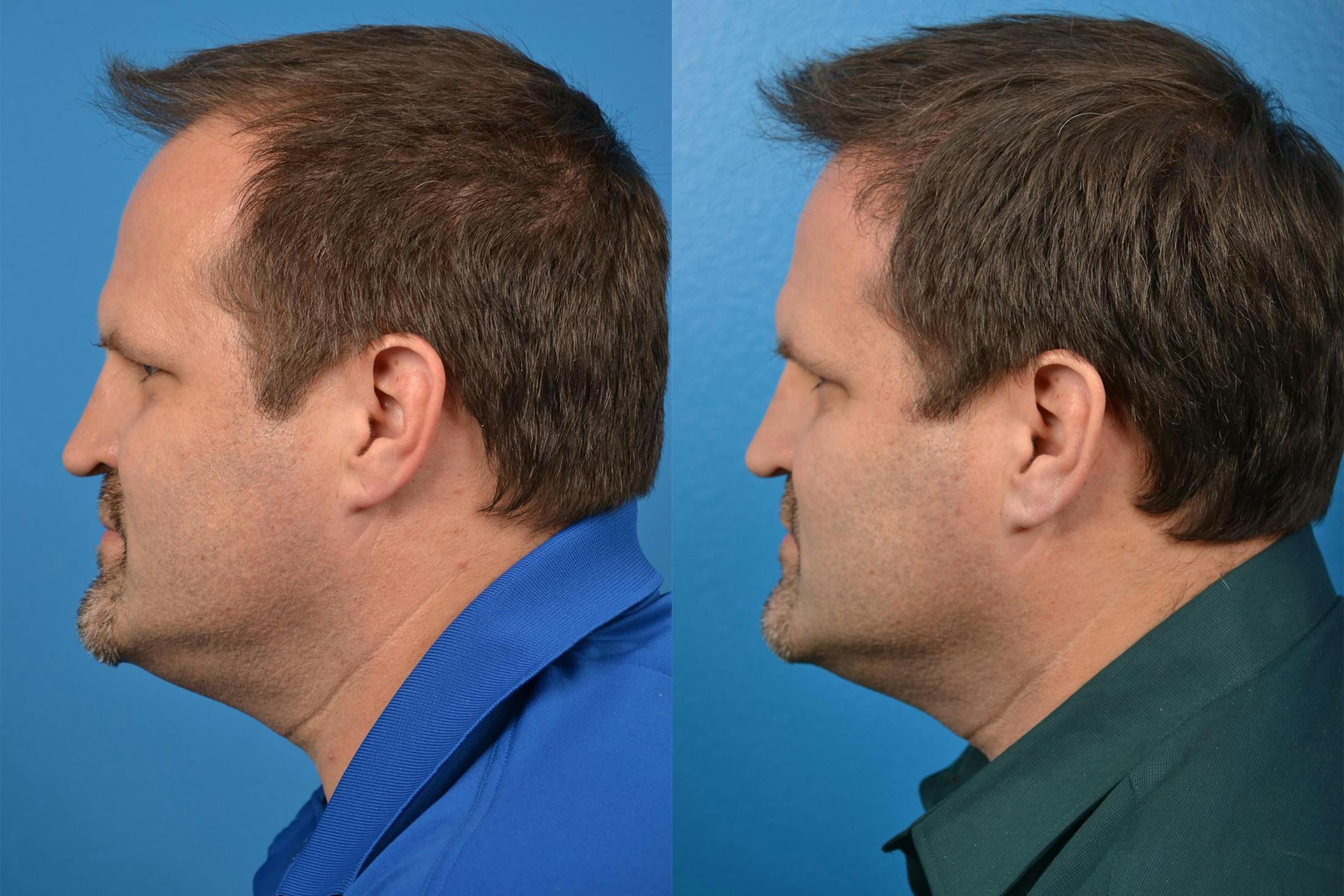 Hair Restoration Before & After Gallery - Patient 122405291 - Image 5