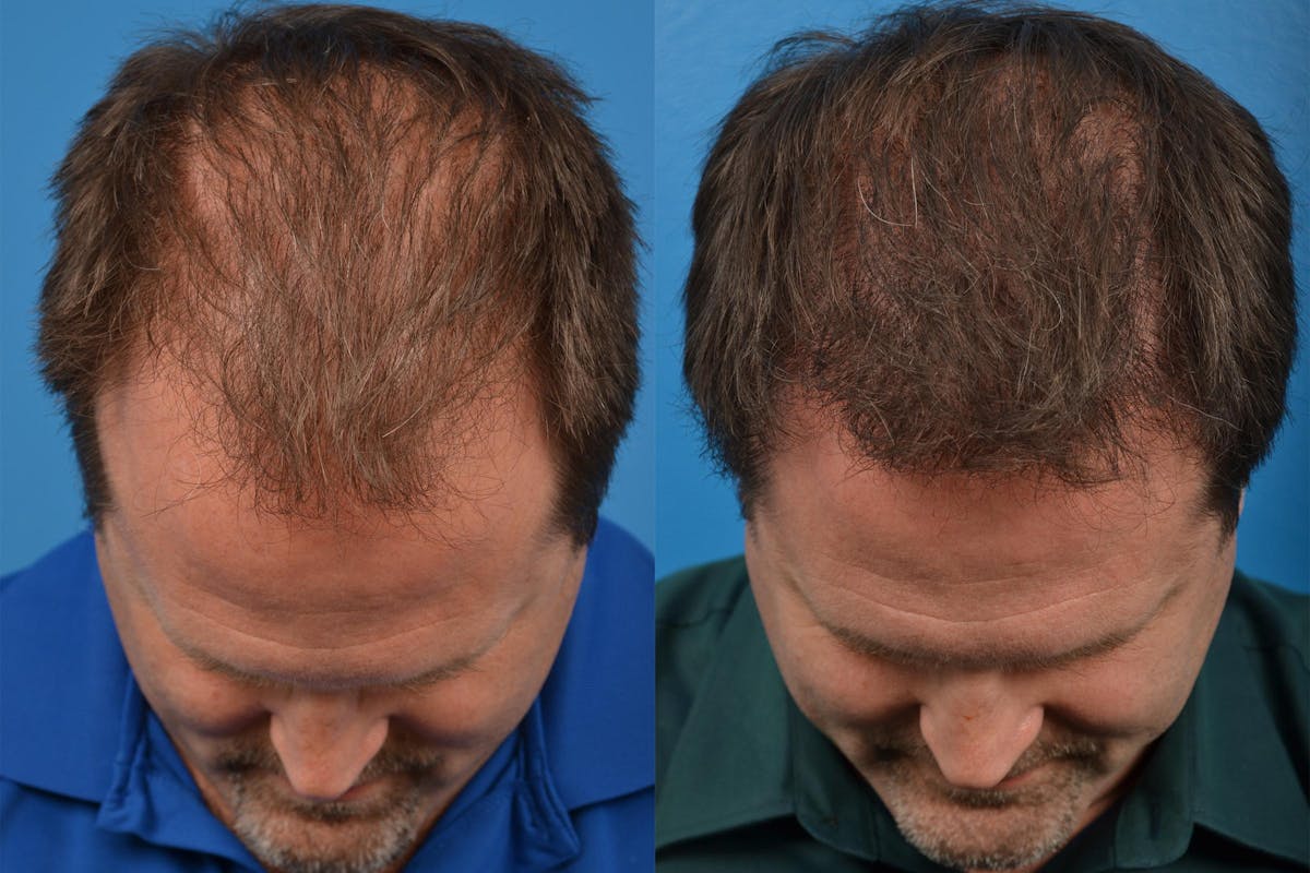Hair Restoration Before & After Gallery - Patient 122405291 - Image 6