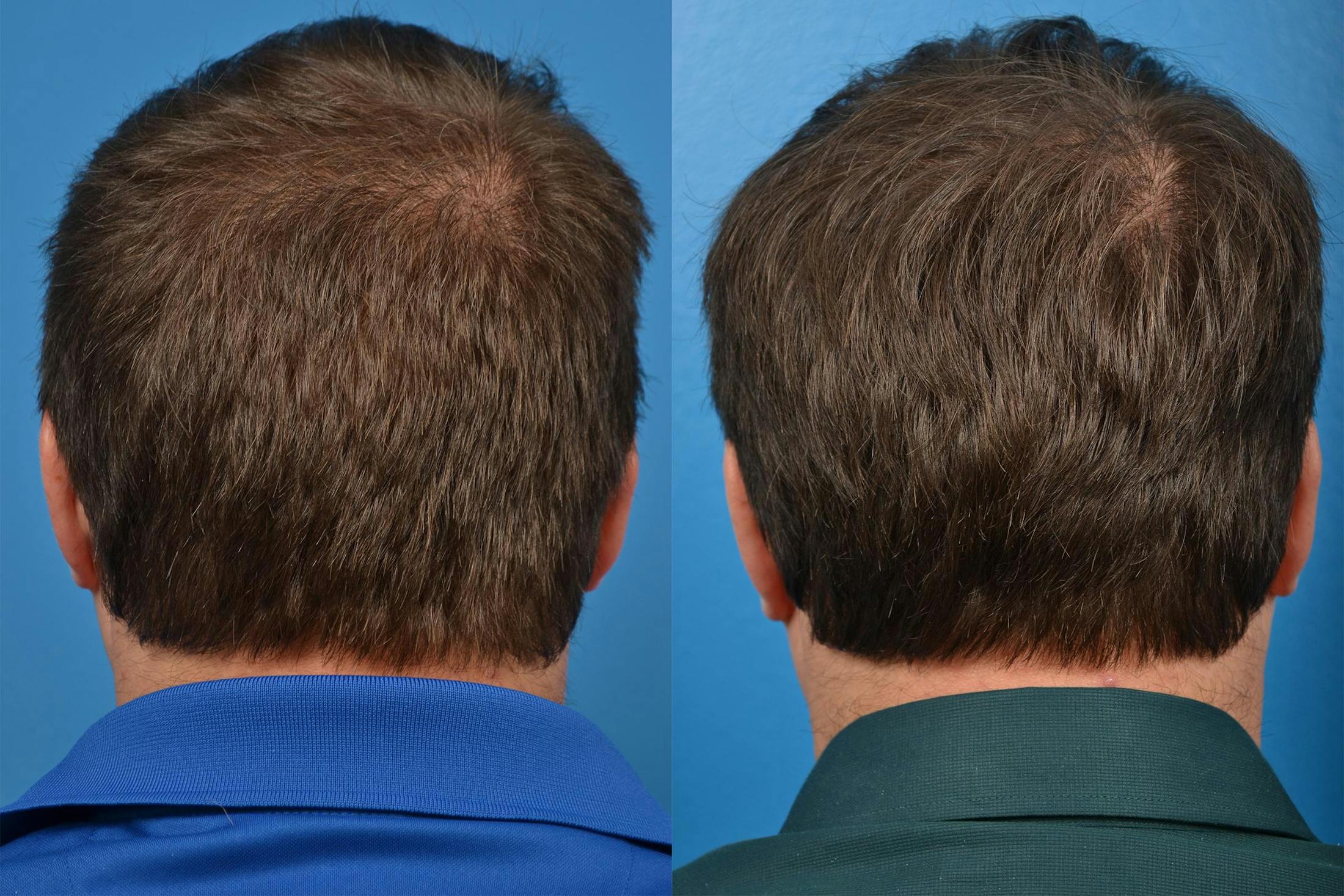 Hair Restoration Before & After Gallery - Patient 122405291 - Image 7