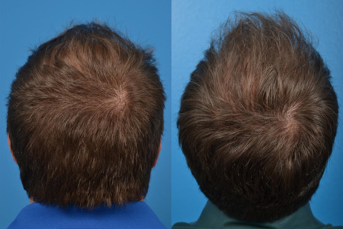 Hair Restoration Before & After Gallery - Patient 122405291 - Image 8