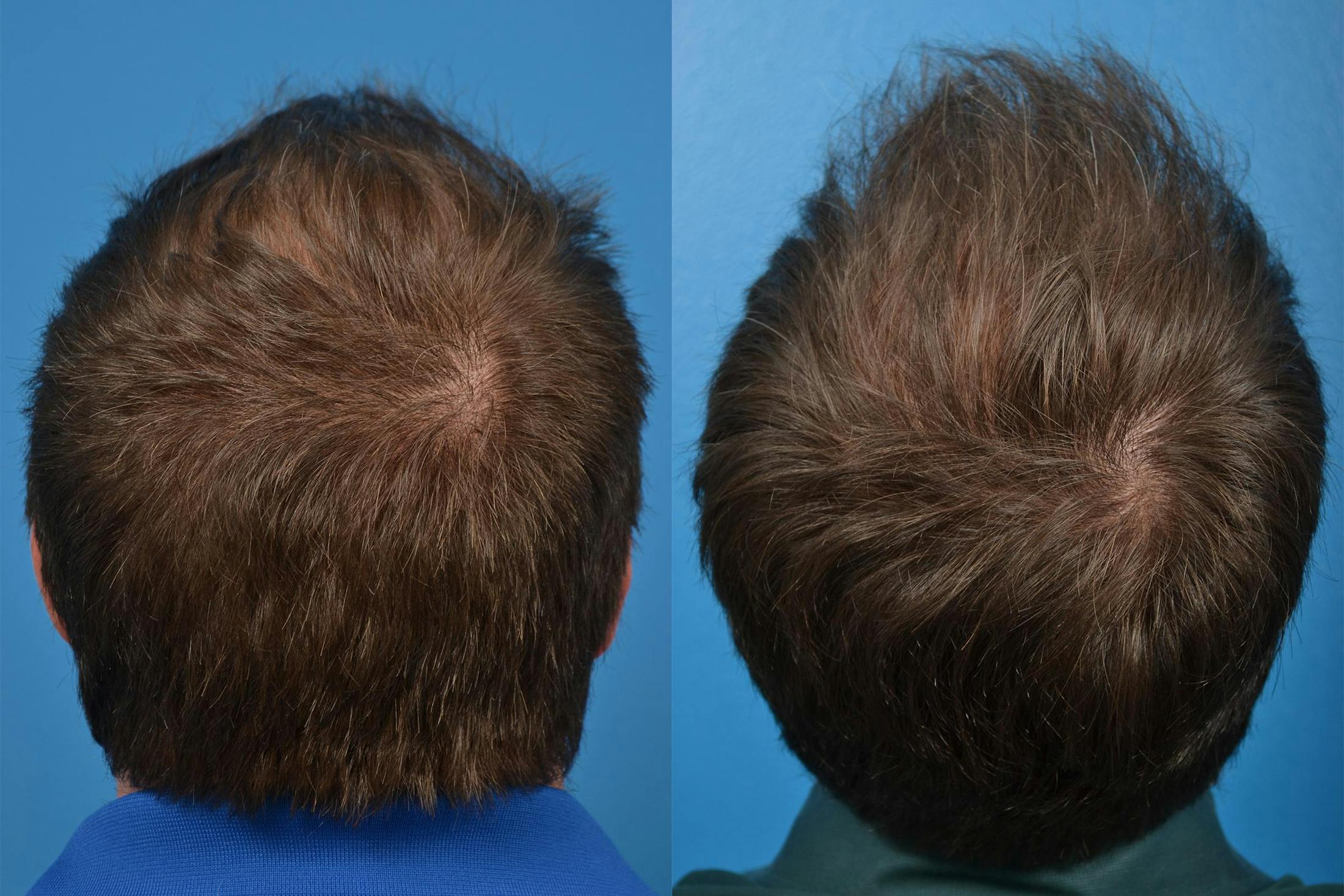 Hair Restoration Before & After Gallery - Patient 122405291 - Image 8
