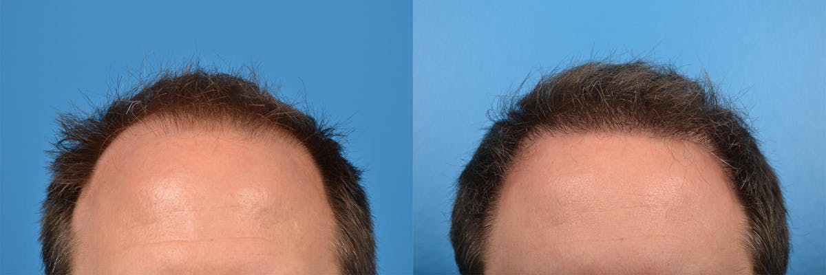 Hair Restoration Before & After Gallery - Patient 122405291 - Image 9