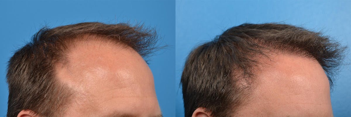 Hair Restoration Before & After Gallery - Patient 122405291 - Image 10