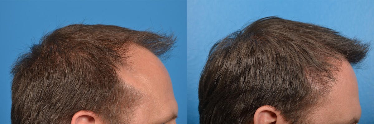 Hair Restoration Before & After Gallery - Patient 122405291 - Image 11