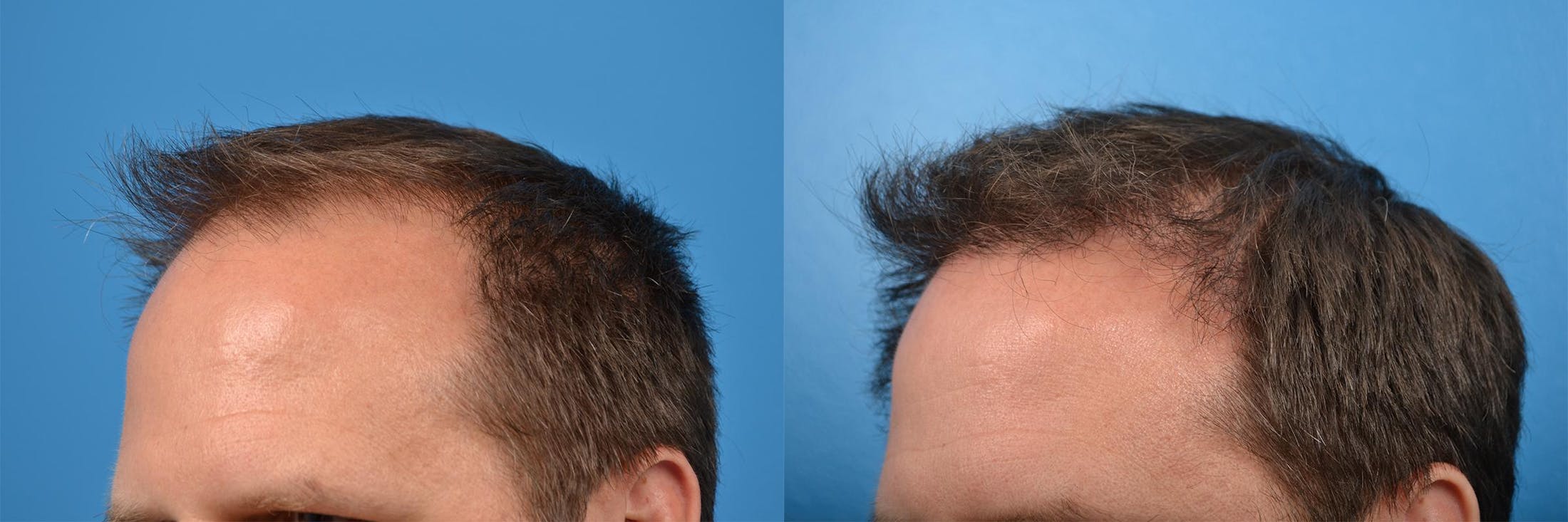 Hair Restoration Before & After Gallery - Patient 122405291 - Image 12