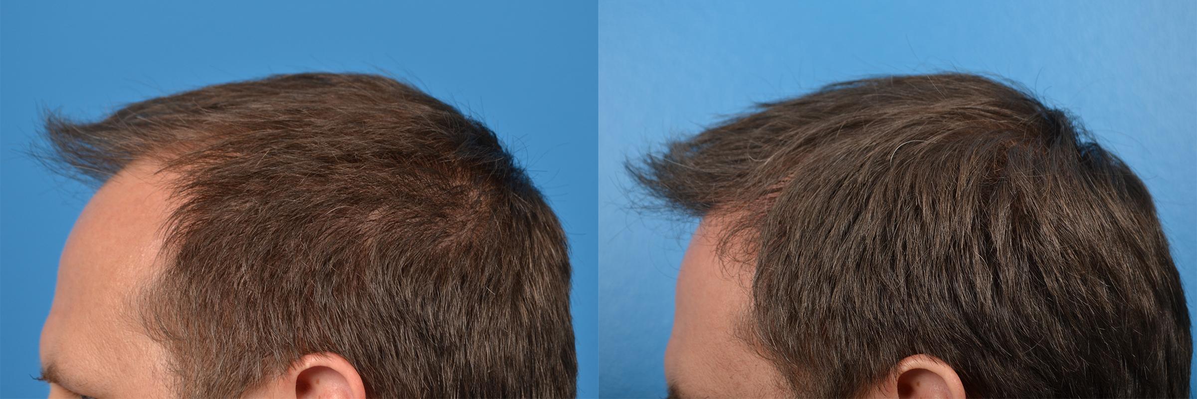Hair Restoration Before & After Gallery - Patient 122405291 - Image 13