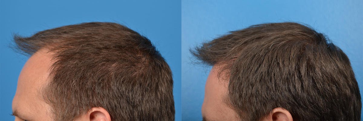Hair Restoration Before & After Gallery - Patient 122405291 - Image 13