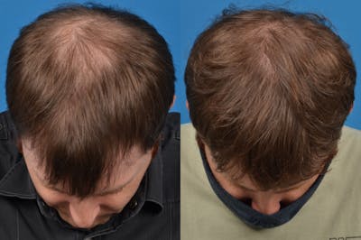 Hair Restoration Before & After Gallery - Patient 122405300 - Image 1