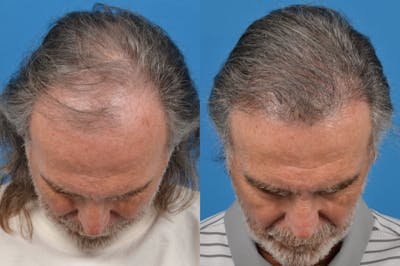 Hair Restoration Before & After Gallery - Patient 122405301 - Image 1