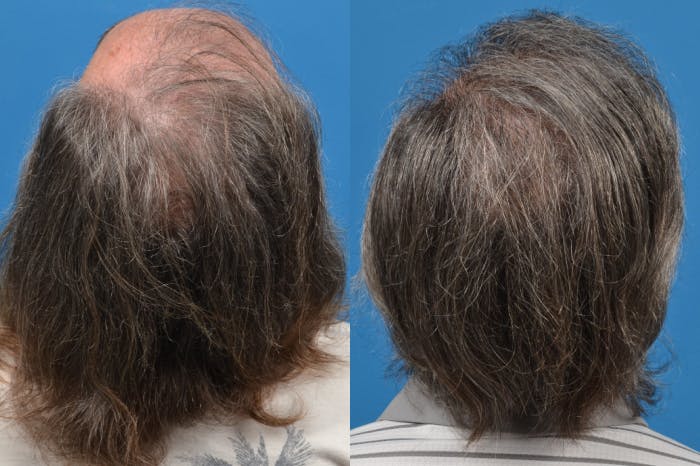 Hair Restoration Before & After Gallery - Patient 122405301 - Image 2