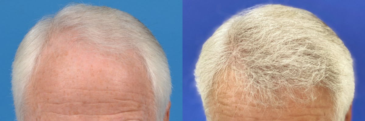 Hair Restoration Before & After Gallery - Patient 122405302 - Image 1