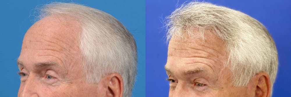 Hair Restoration Before & After Gallery - Patient 122405302 - Image 2
