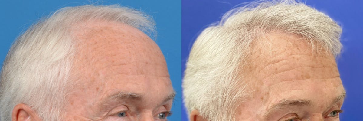 Hair Restoration Before & After Gallery - Patient 122405302 - Image 3