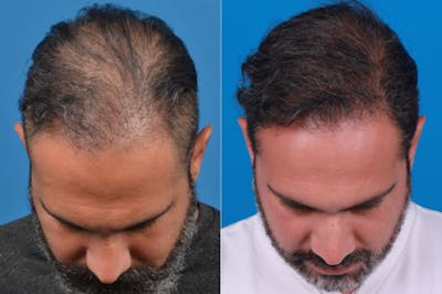 Hair Restoration Before & After Gallery - Patient 122405303 - Image 1