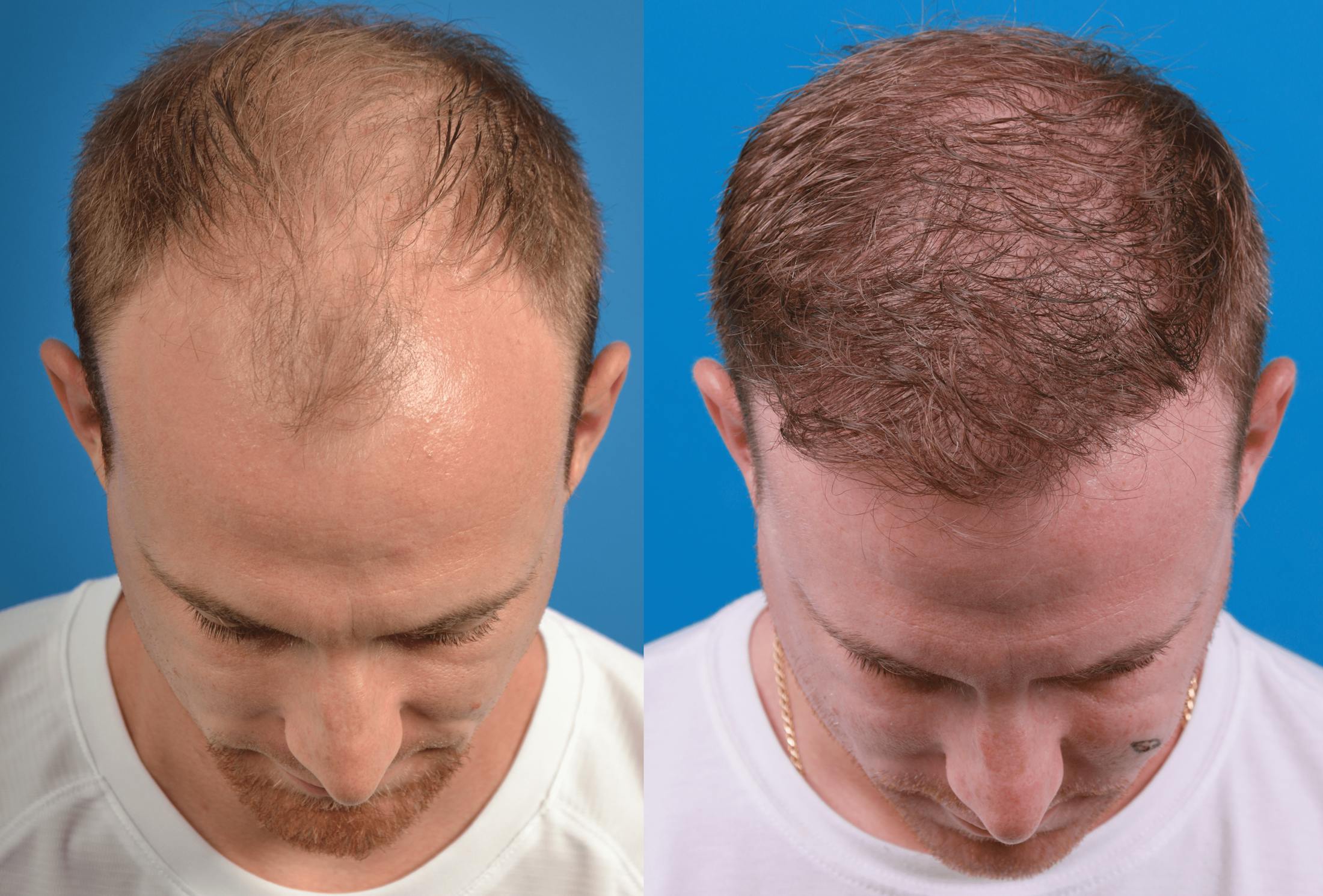 Hair Restoration Before & After Gallery - Patient 122405306 - Image 1