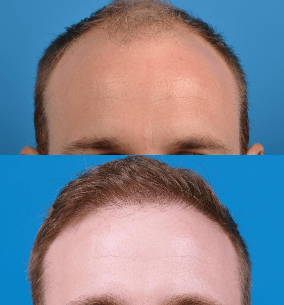 Hair Restoration Before & After Gallery - Patient 122405306 - Image 2