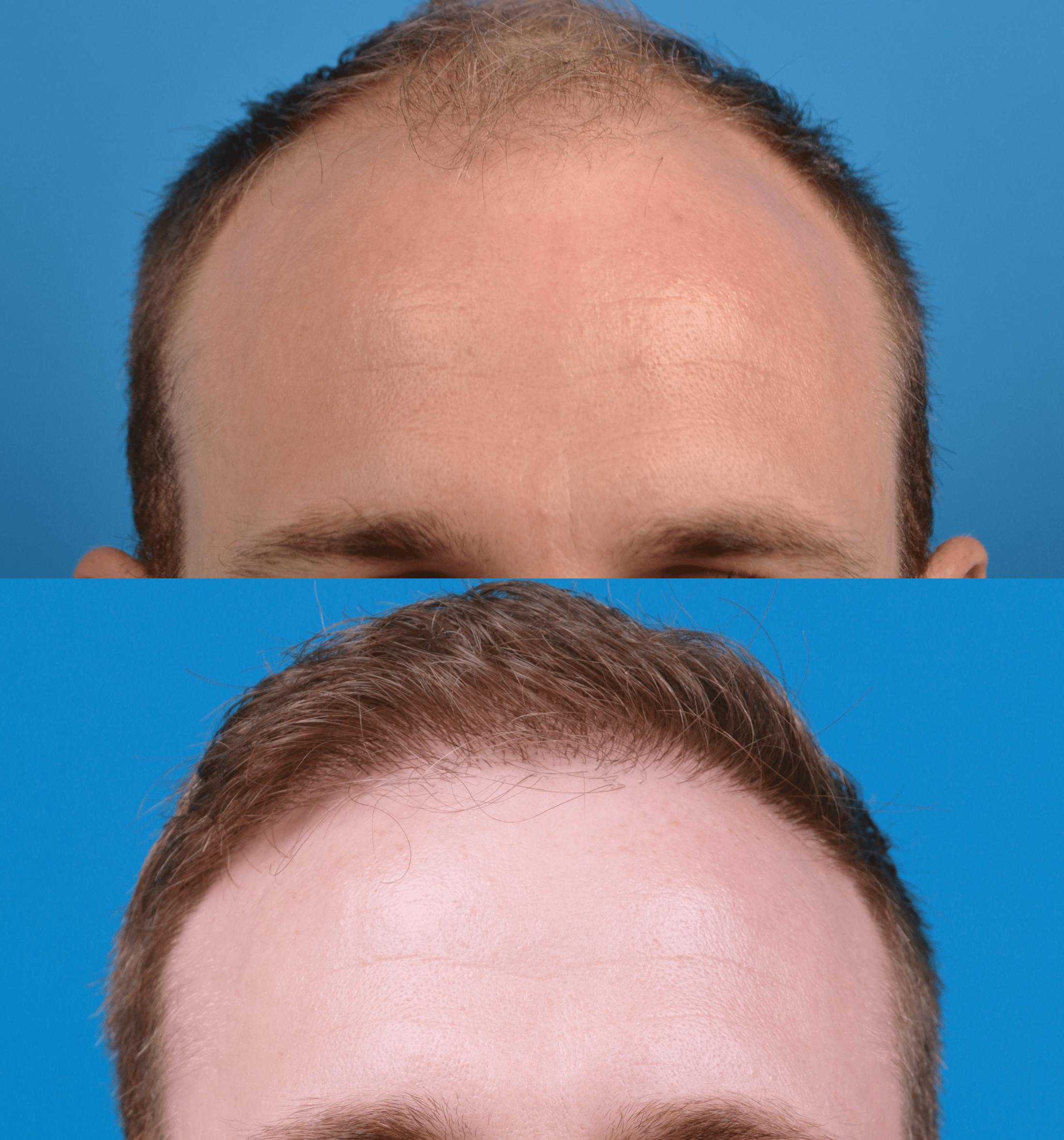 Hair Restoration Before & After Gallery - Patient 122405306 - Image 2