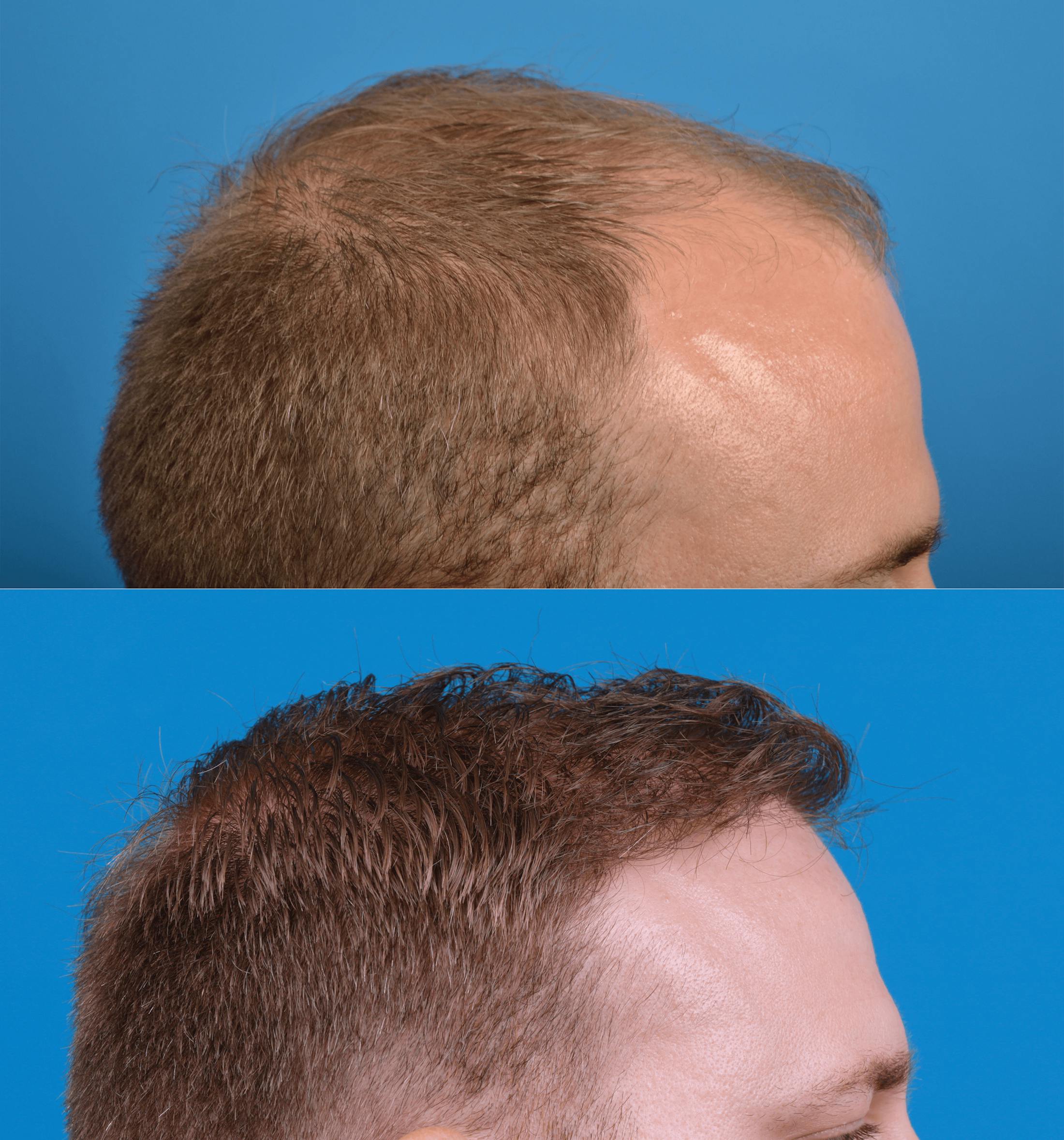 Hair Restoration Before & After Gallery - Patient 122405306 - Image 3