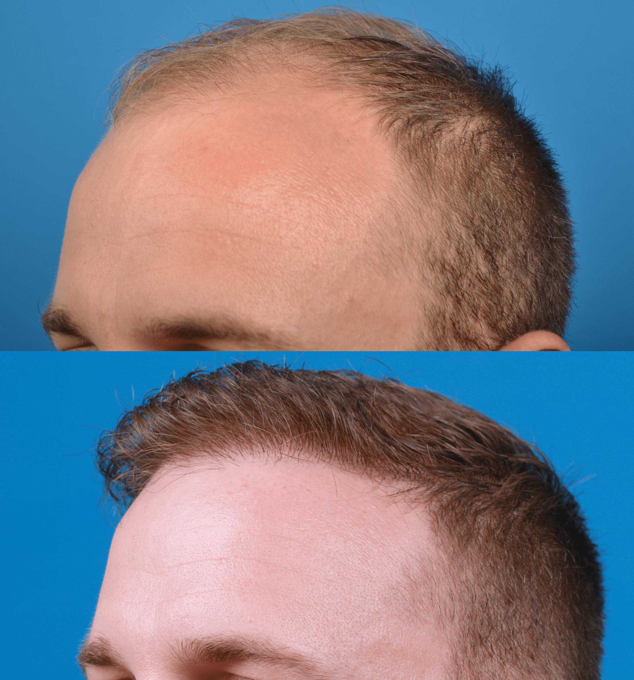 Hair Restoration Before & After Gallery - Patient 122405306 - Image 4