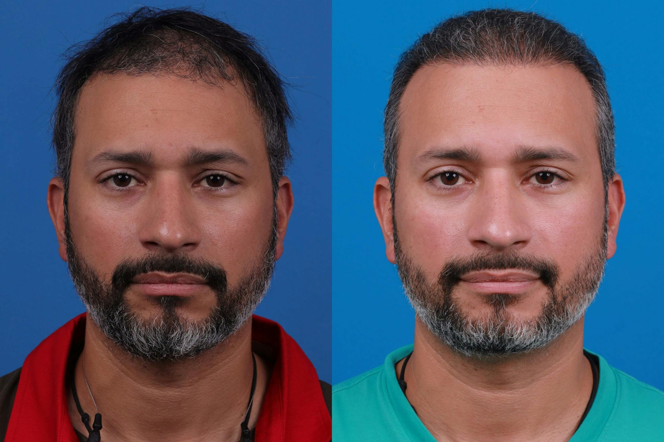 Hair Restoration Before & After Gallery - Patient 122405307 - Image 1
