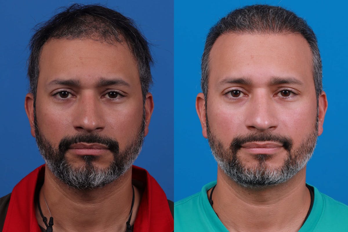 Hair Restoration Before & After Gallery - Patient 122405307 - Image 1