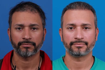 Hair Restoration Before & After Gallery - Patient 122405307 - Image 1