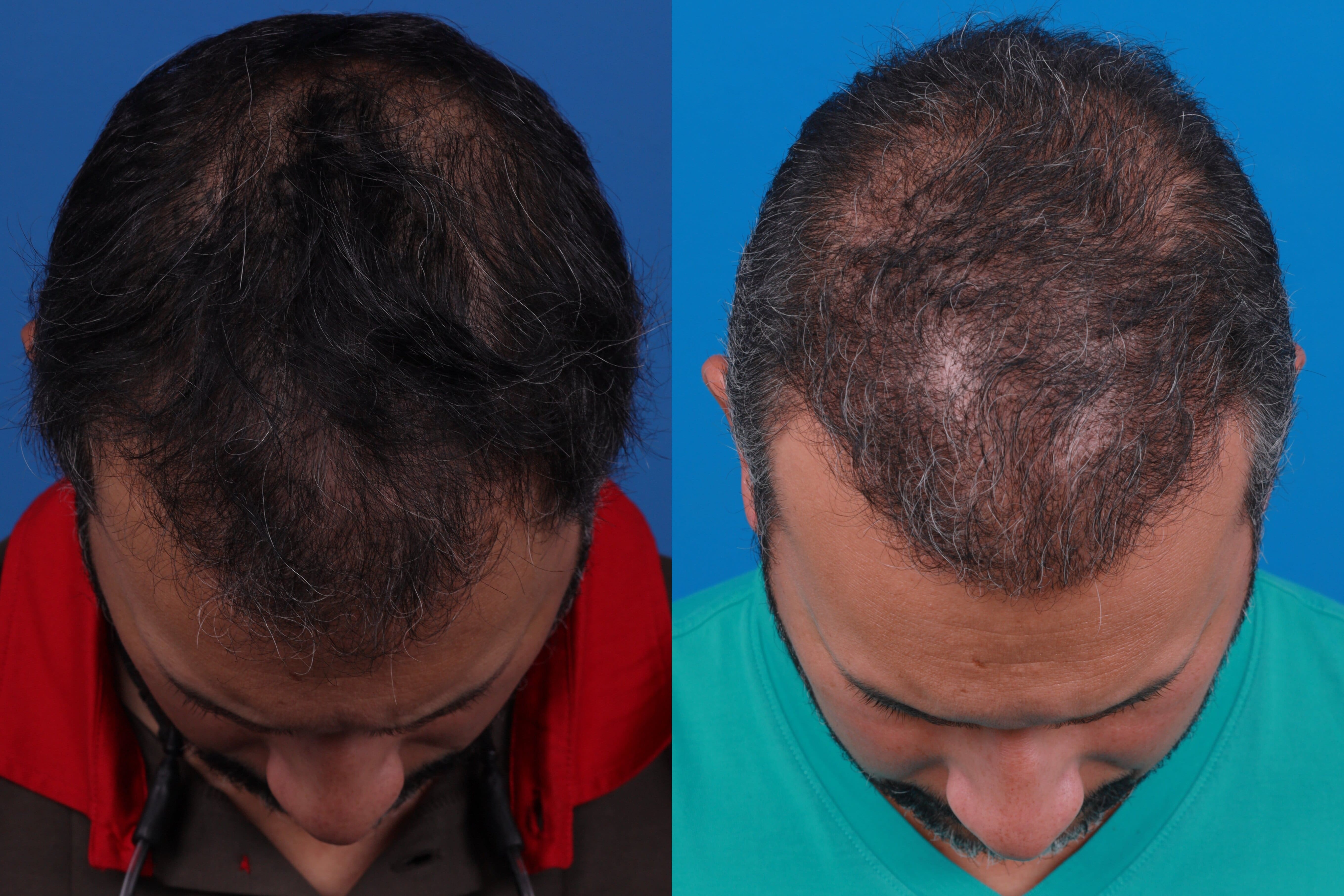Hair Restoration Before & After Gallery - Patient 122405307 - Image 2